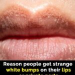 What Are Those White Bumps That Can Appear On Your Private Parts and What Causes Them?