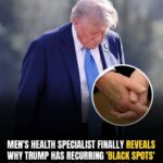 Men’s Health Specialist Finally Reveals Why Trump Has Recurring ‘Black Spots’ On His Hands, And We Had No Idea