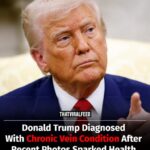 Donald Trump Diagnosed With Vein Condition After Recent Photos Sparked Health Concerns