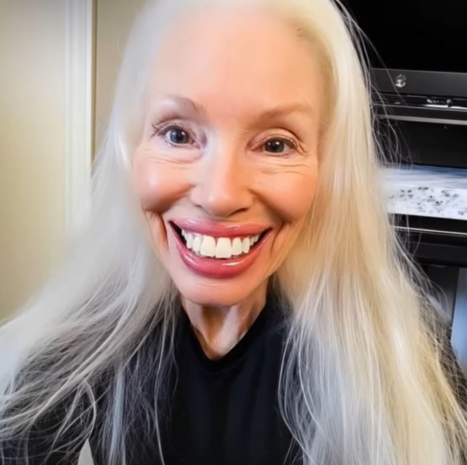 She Stole My College Fund for a Perfect Smile — Then Karma Wiped That Grin Off Her Face