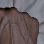 5 Health Conditions That Can Cause Visible Veins