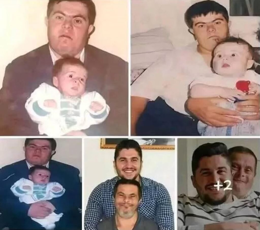 A father with Down syndrome raised his son, who is now a doctor