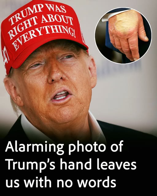 Alarming photo of Trump’s hand sparks deep concern