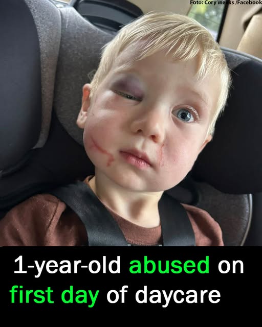 Daycare worker arrested after toddler arrives with black eye and swollen face on first day