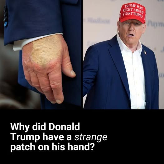 Extent of Donald Trump’s dark hand bruising revealed days after he covered it up