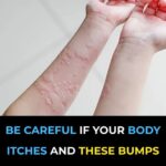 Surprising Causes Of Hives Revealed