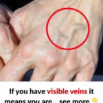The Truth About Those Surprise Veins You’re Seeing