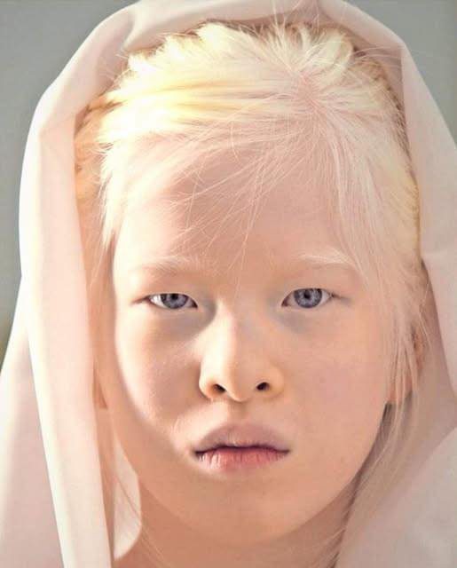 Girl abandoned at birth for her looks wants to prove the world wrong – she now models for Vogue.