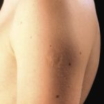 Smallpox vaccine scars: What they look like and why