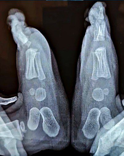 Why Babies Shouldn’t Wear Shoes Too Early: A Guide to Foot Development