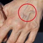 Why Your Veins Appear More Prominent Overnight