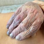 3 Signs on Your Hands That Could Indicate Heart Disease or Cancer