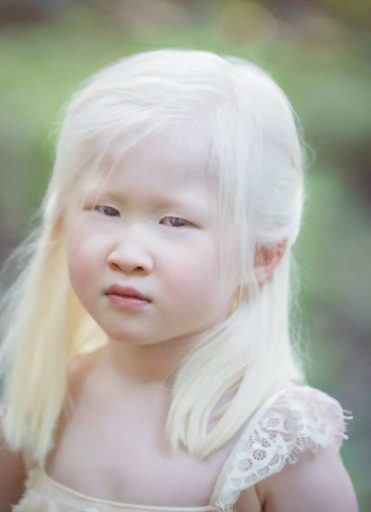 A baby girl born with albinism was abandoned by her parents, She looked too weird for them and left her at an orphanage door