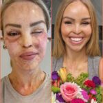 Katie Piper’s Triumph: 17 Years After Acid Attack, She Stuns the World in a Blue Bikini