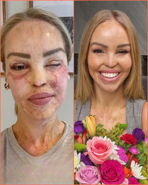 Katie Piper’s Triumph: 17 Years After Acid Attack, She Stuns the World in a Blue Bikini